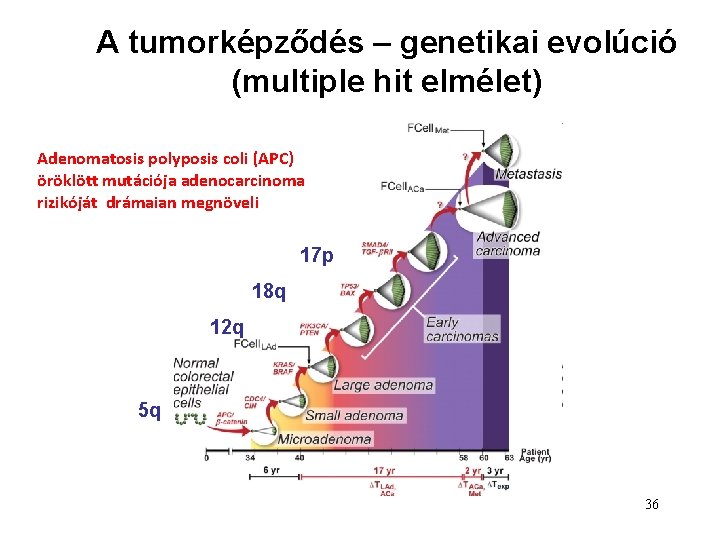 A tumorképződés – genetikai evolúció (multiple hit elmélet) Adenomatosis polyposis coli (APC) öröklött mutációja