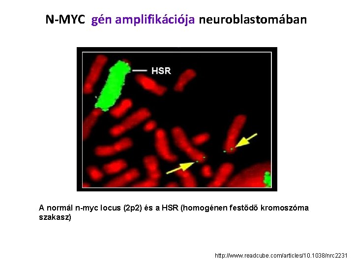 N-MYC gén amplifikációja neuroblastomában A normál n-myc locus (2 p 2) és a HSR