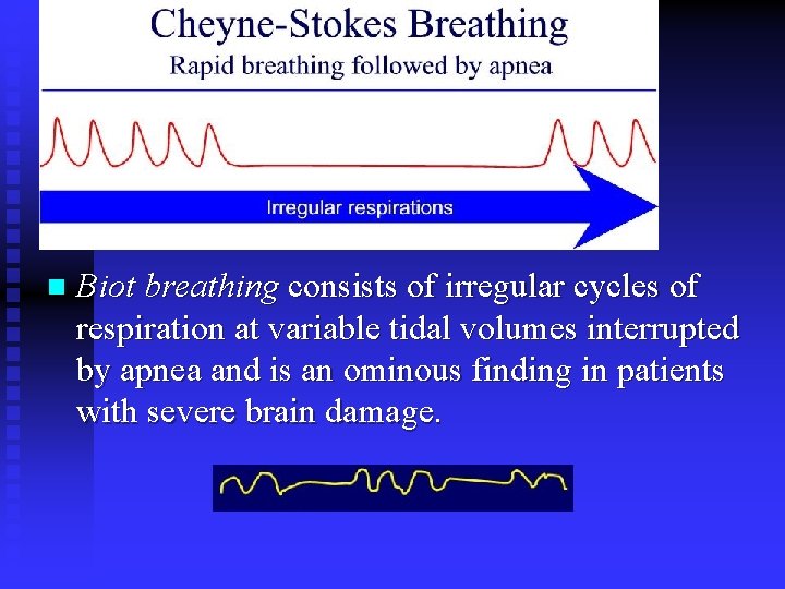 n Biot breathing consists of irregular cycles of respiration at variable tidal volumes interrupted