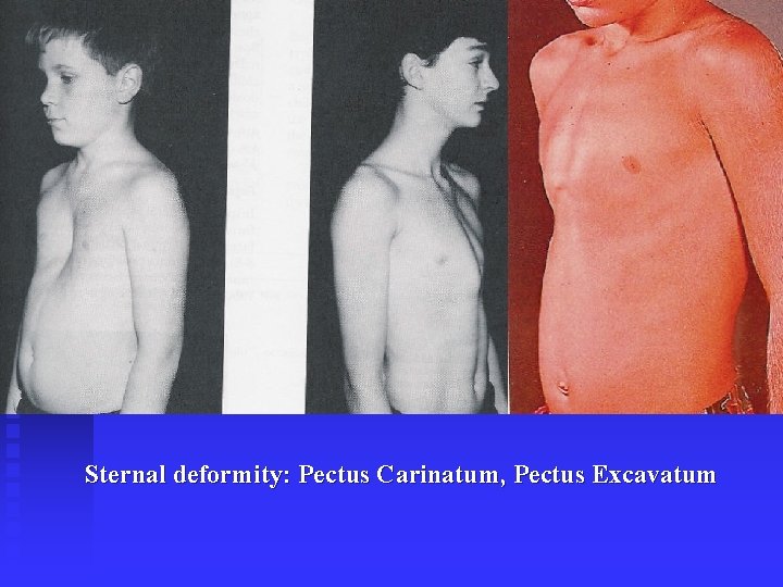 Sternal deformity: Pectus Carinatum, Pectus Excavatum 