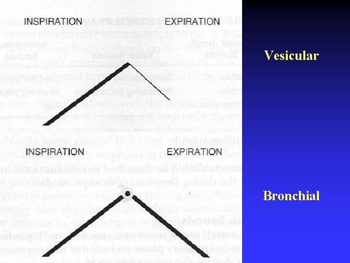 Vesicular Bronchial 