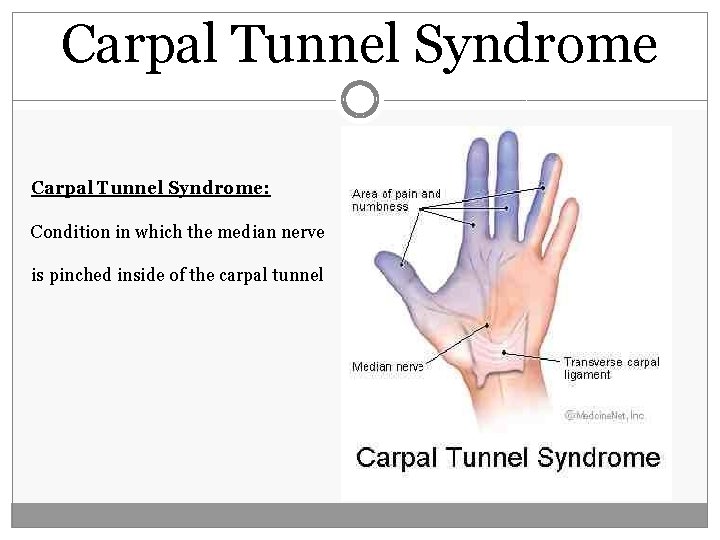 Carpal Tunnel Syndrome: Condition in which the median nerve is pinched inside of the