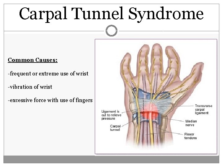 Carpal Tunnel Syndrome Common Causes: -frequent or extreme use of wrist -vibration of wrist