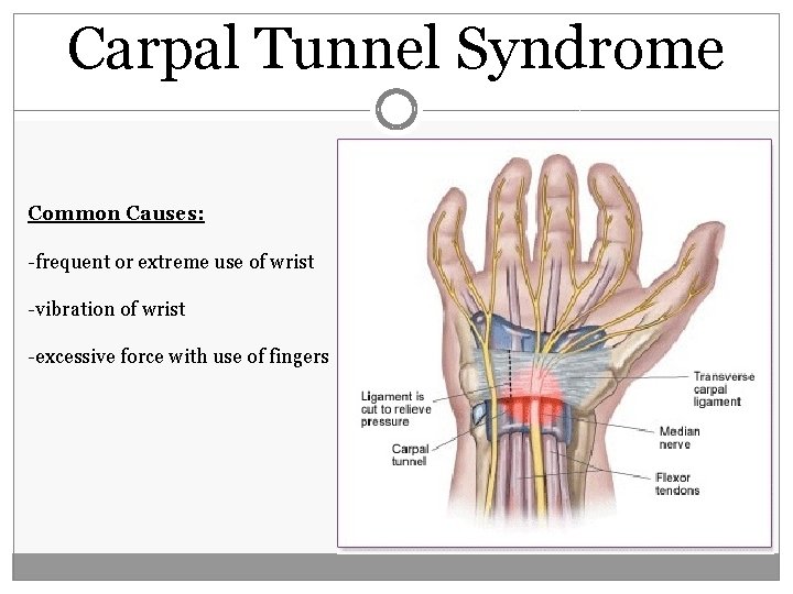 Carpal Tunnel Syndrome Common Causes: -frequent or extreme use of wrist -vibration of wrist Carpal Tunnel Syndrome Common Causes: -frequent or extreme use of wrist -vibration of wrist