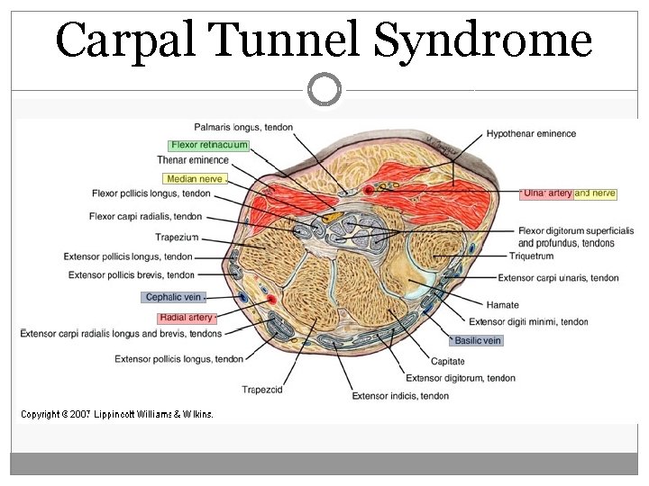 Carpal Tunnel Syndrome  Carpal Tunnel Syndrome