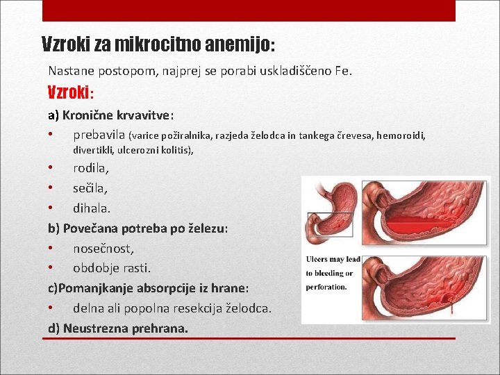 Vzroki za mikrocitno anemijo: Nastane postopom, najprej se porabi uskladiščeno Fe. Vzroki: a) Kronične