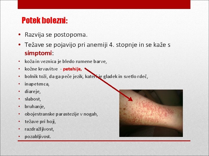Potek bolezni: • Razvija se postopoma. • Težave se pojavijo pri anemiji 4. stopnje