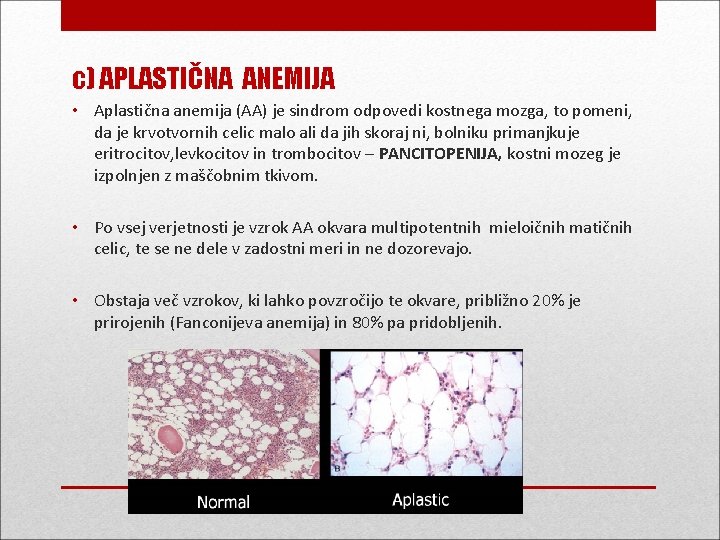 c) APLASTIČNA ANEMIJA • Aplastična anemija (AA) je sindrom odpovedi kostnega mozga, to pomeni,