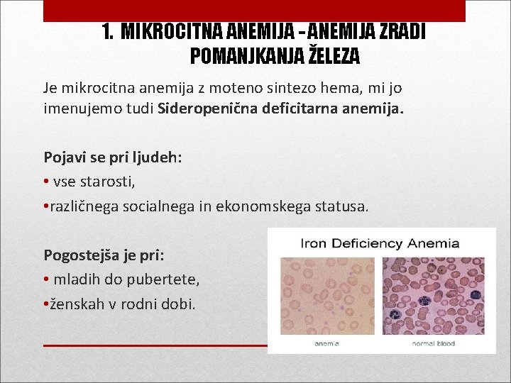 1. MIKROCITNA ANEMIJA - ANEMIJA ZRADI POMANJKANJA ŽELEZA Je mikrocitna anemija z moteno sintezo