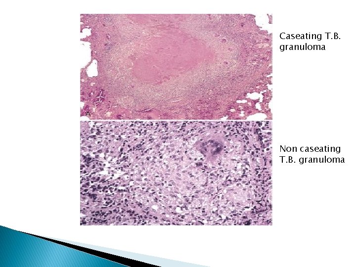 Caseating T. B. granuloma Non caseating T. B. granuloma 