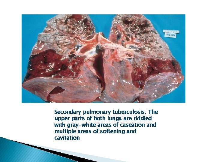 Secondary pulmonary tuberculosis. The upper parts of both lungs are riddled with gray-white areas