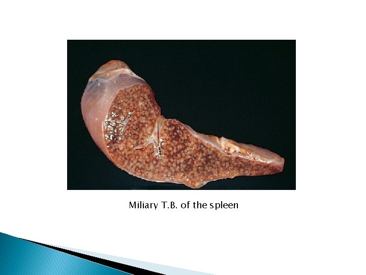 Miliary T. B. of the spleen 