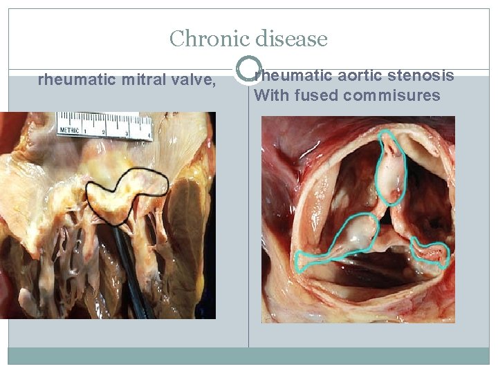 Chronic disease rheumatic mitral valve, rheumatic aortic stenosis With fused commisures 