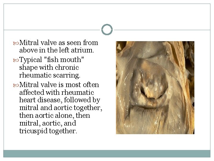  Mitral valve as seen from above in the left atrium. Typical "fish mouth"