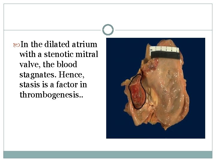  In the dilated atrium with a stenotic mitral valve, the blood stagnates. Hence,