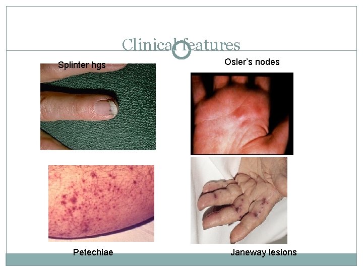 Clinical features Splinter hgs Petechiae Osler’s nodes Janeway lesions 