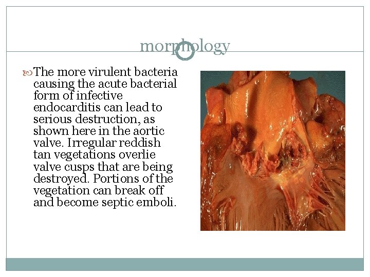morphology The more virulent bacteria causing the acute bacterial form of infective endocarditis can morphology The more virulent bacteria causing the acute bacterial form of infective endocarditis can