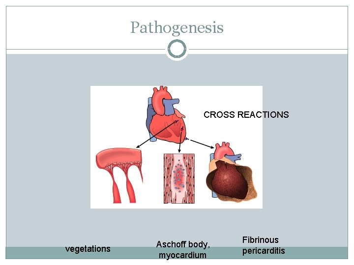 Pathogenesis CROSS REACTIONS vegetations Aschoff body, myocardium Fibrinous pericarditis 