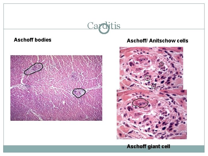 Carditis Aschoff bodies Aschoff/ Anitschow cells Aschoff giant cell 