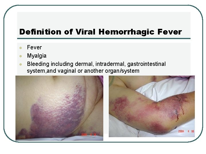 Definition of Viral Hemorrhagic Fever l l l Fever Myalgia Bleeding including dermal, intradermal,