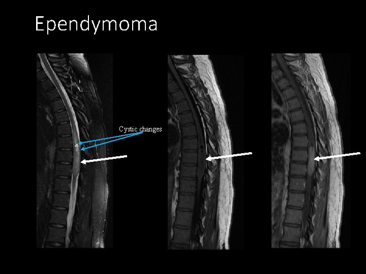 Ependymoma Cystic changes Sagittal T 2 Sagittal T 1 Post-contrast sagittal T 1 