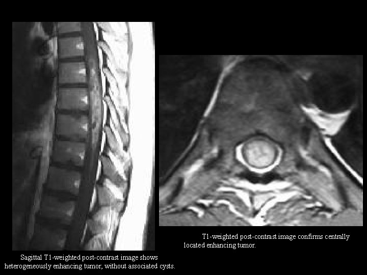 Axial T 1 -weighted post-contrast image confirms centrally located enhancing tumor. Sagittal T 1