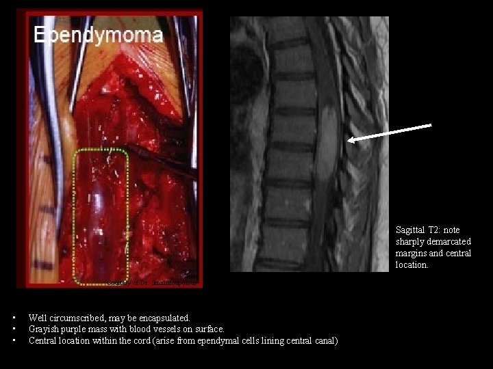 Sagittal T 2: note sharply demarcated margins and central location. Courtesy of Dr. Smirnitoupolous.