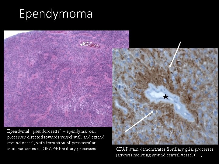 Ependymoma Ependymal “pseudorosette” – ependymal cell processes directed towards vessel wall and extend around