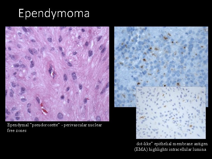 Ependymoma Ependymal “pseudorosette” - perivascular nuclear free zones “dot-like” epithelial membrane antigen (EMA) highlights