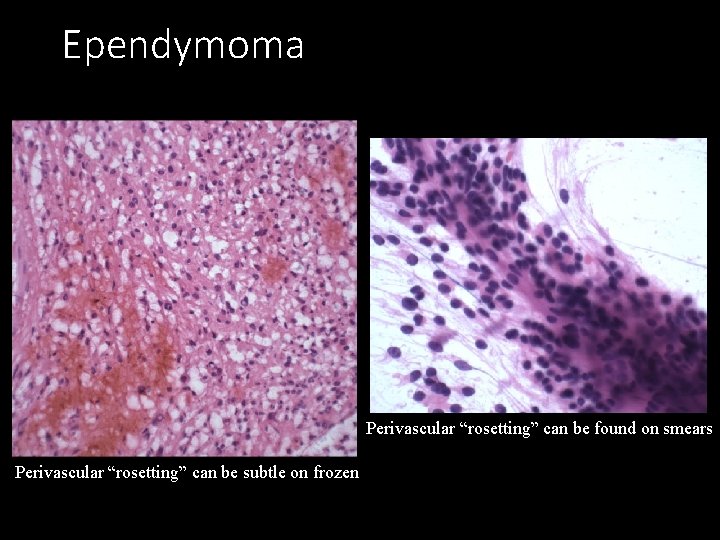 Ependymoma Perivascular “rosetting” can be found on smears Perivascular “rosetting” can be subtle on