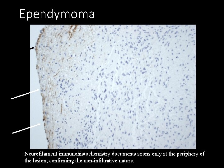Ependymoma Neurofilament immunohistochemistry documents axons only at the periphery of the lesion, confirming the