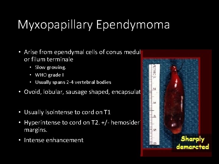 Myxopapillary Ependymoma • Arise from ependymal cells of conus medullaris or filum terminale •