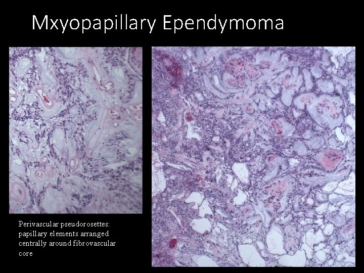 Mxyopapillary Ependymoma Perivascular pseudorosettes: papillary elements arranged centrally around fibrovascular core 