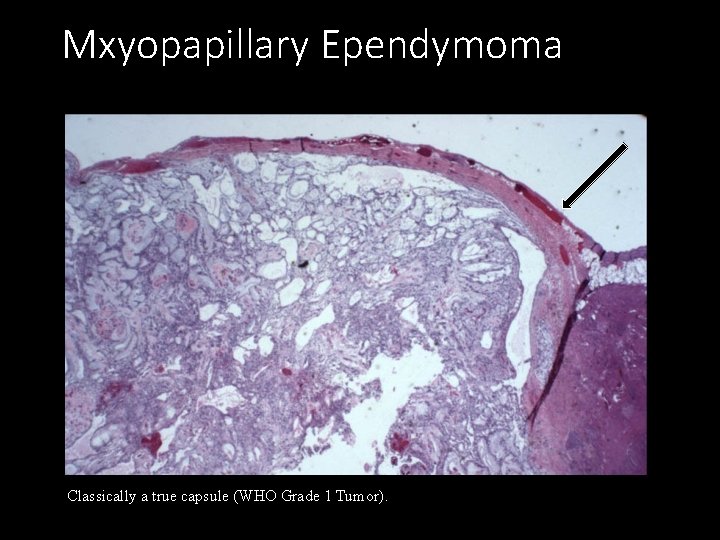 Mxyopapillary Ependymoma Classically a true capsule (WHO Grade 1 Tumor). 
