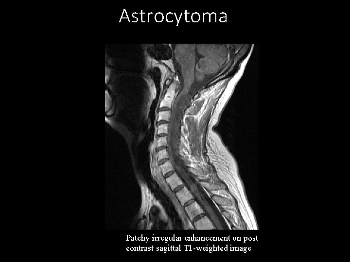 Astrocytoma Patchy irregular enhancement on post contrast sagittal T 1 -weighted image 