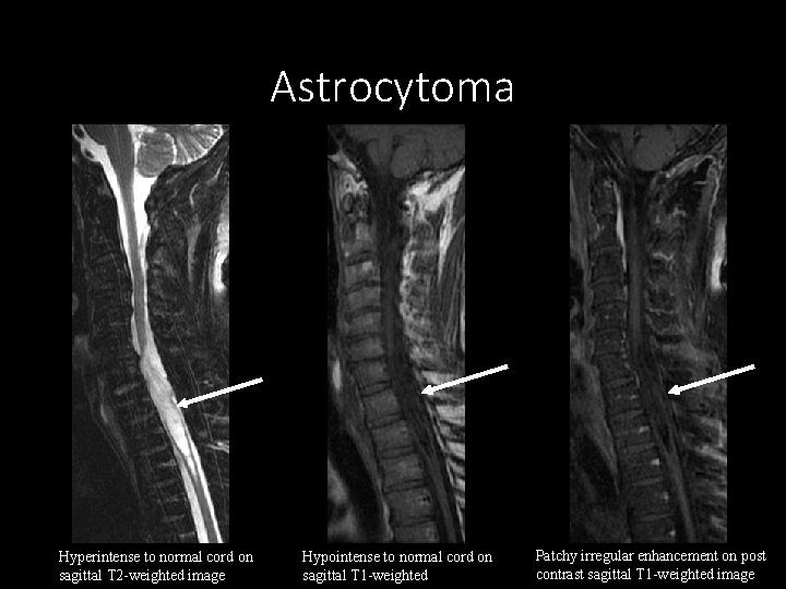 Astrocytoma Hyperintense to normal cord on sagittal T 2 -weighted image Hypointense to normal