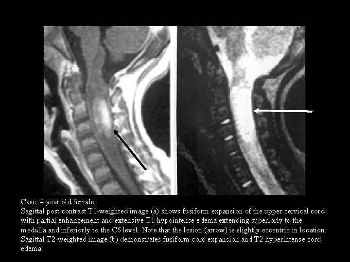 (a) (b) Case: 4 year old female. Sagittal post contrast T 1 -weighted image