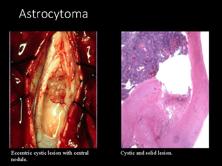 Astrocytoma Eccentric cystic lesion with central nodule. Cystic and solid lesion. 