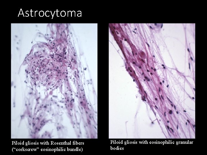 Astrocytoma Piloid gliosis with Rosenthal fibers (“corkscrew” eosinophilic bundle) Piloid gliosis with eosinophilic granular