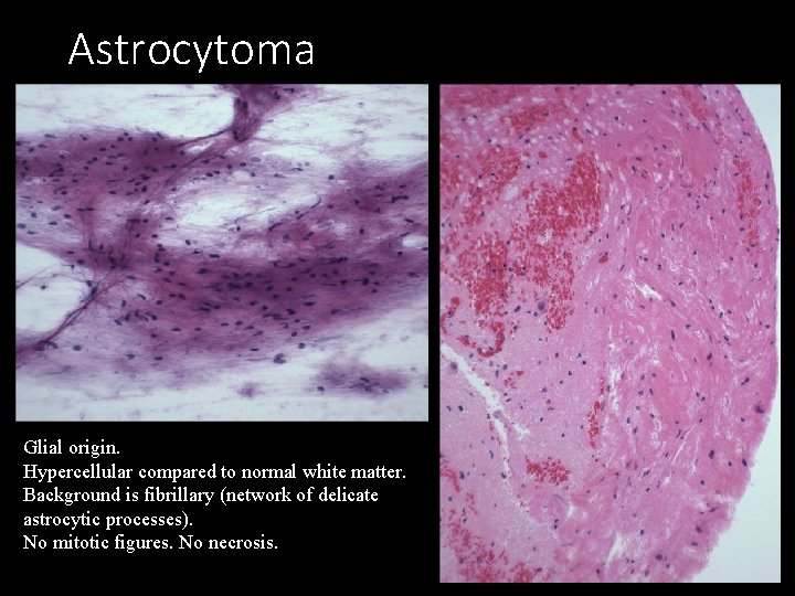Astrocytoma Glial origin. Hypercellular compared to normal white matter. Background is fibrillary (network of