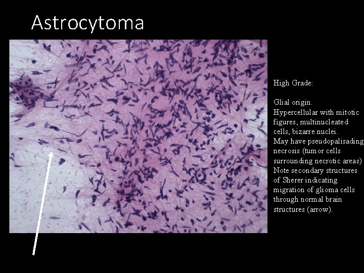 Astrocytoma High Grade: Glial origin. Hypercellular with mitotic figures, multinucleated cells, bizarre nuclei. May