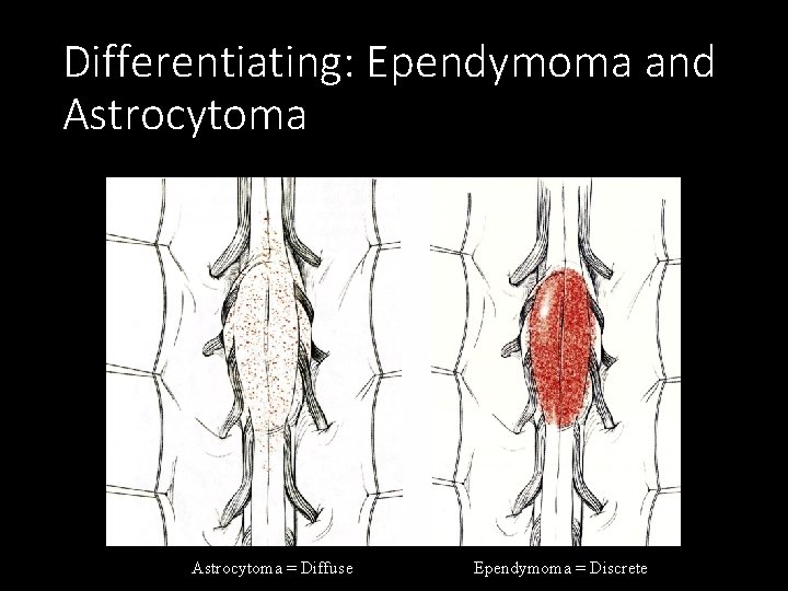 Differentiating: Ependymoma and Astrocytoma = Diffuse Ependymoma = Discrete 