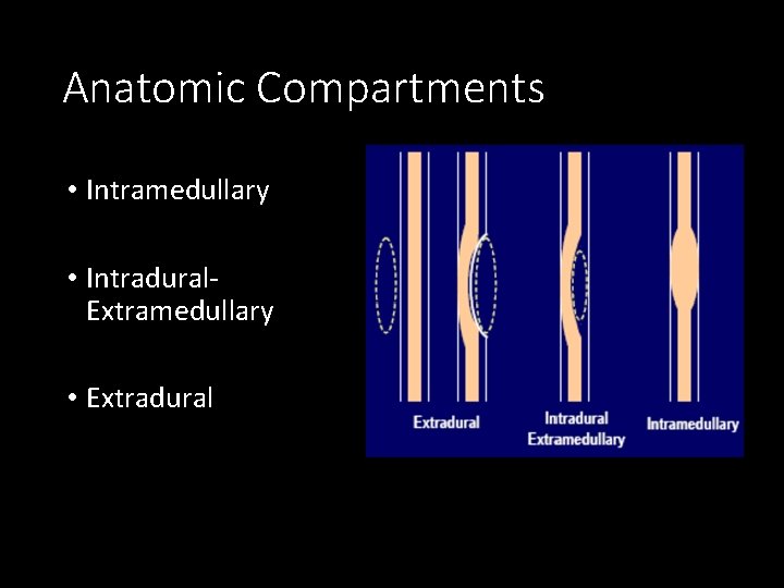 Anatomic Compartments • Intramedullary • Intradural. Extramedullary • Extradural 