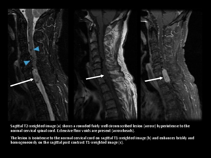 (a) (b) (c) Sagittal T 2 -weighted image (a) shows a rounded fairly well