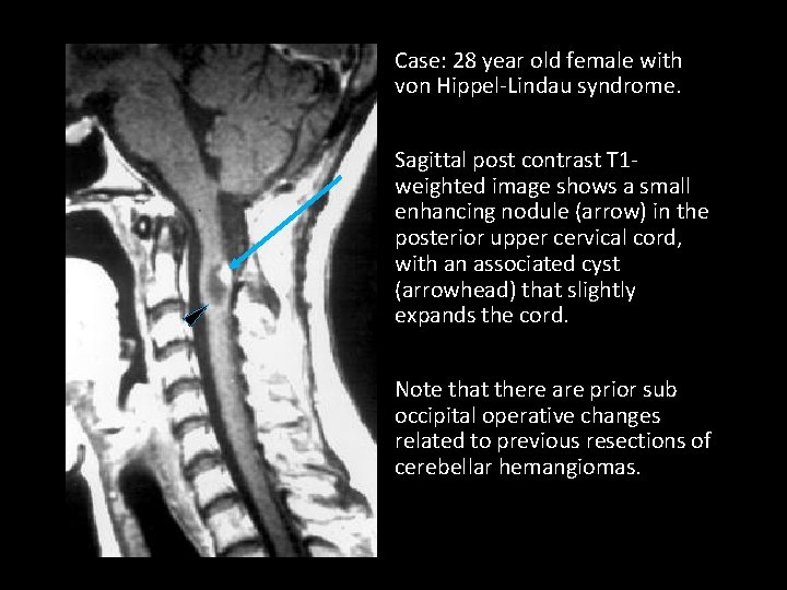Case: 28 year old female with von Hippel-Lindau syndrome. Sagittal post contrast T 1