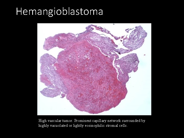 Hemangioblastoma High vascular tumor. Prominent capillary network surrounded by highly vacuolated or lightly eosinophilic