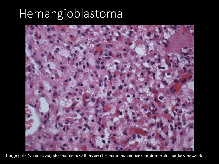 Hemangioblastoma Large pale (vacuolated) stromal cells with hyperchromatic nuclei, surrounding rich capillary network. 