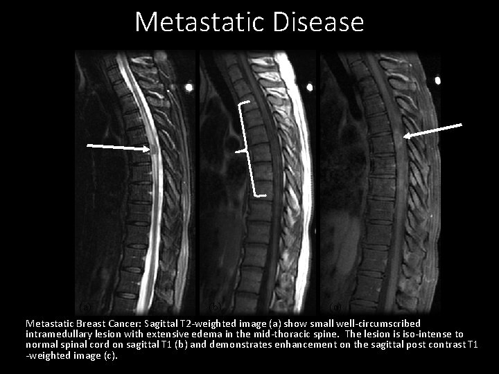Metastatic Disease (a) (b) (c) Metastatic Breast Cancer: Sagittal T 2 -weighted image (a)