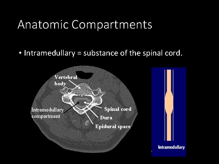 Anatomic Compartments • Intramedullary = substance of the spinal cord. Vertebral body Intramedullary compartment