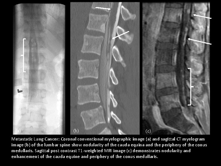 (a) (b) (c) Metastatic Lung Cancer: Coronal conventional myelographic image (a) and sagittal CT